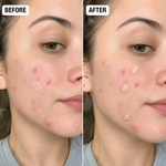 Alvea + Clear Patch